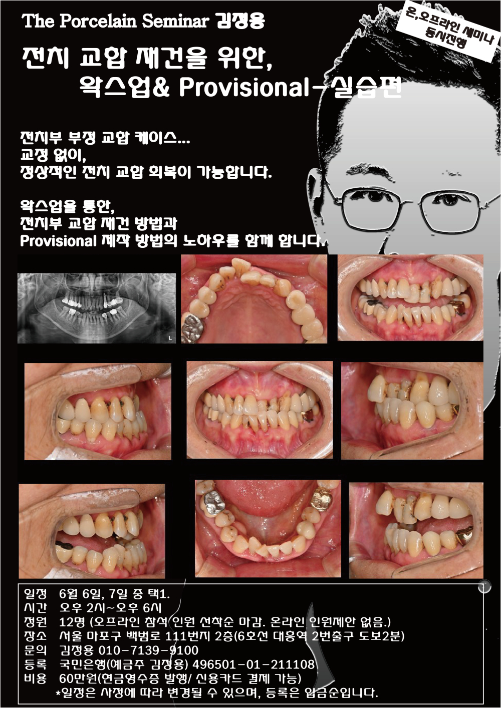 김정용_12.전치교합재건왁스업프로비저널.jpg