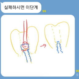 크라운제거.png